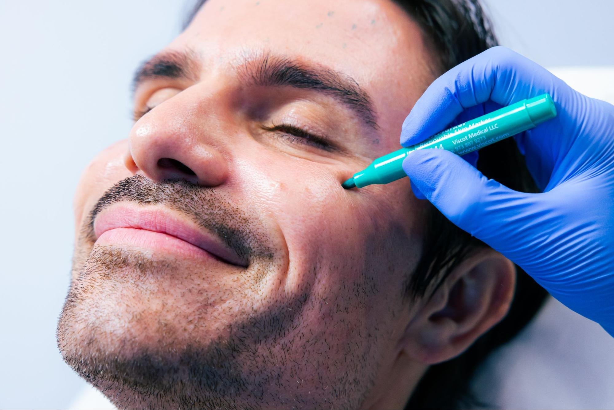 A medspa client smiles as their face is marked for treatment